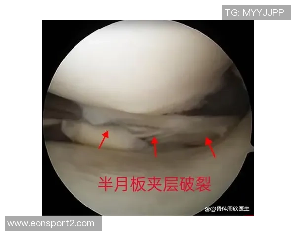 尤文图斯官方宣布加蒂右膝半月板受伤将接受手术治疗恢复健康